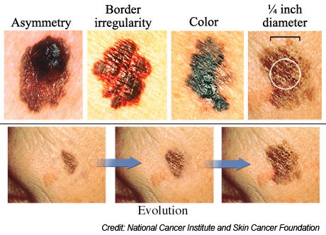 ABCDs of skin cancer