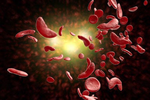 Living with Sickle cELL
