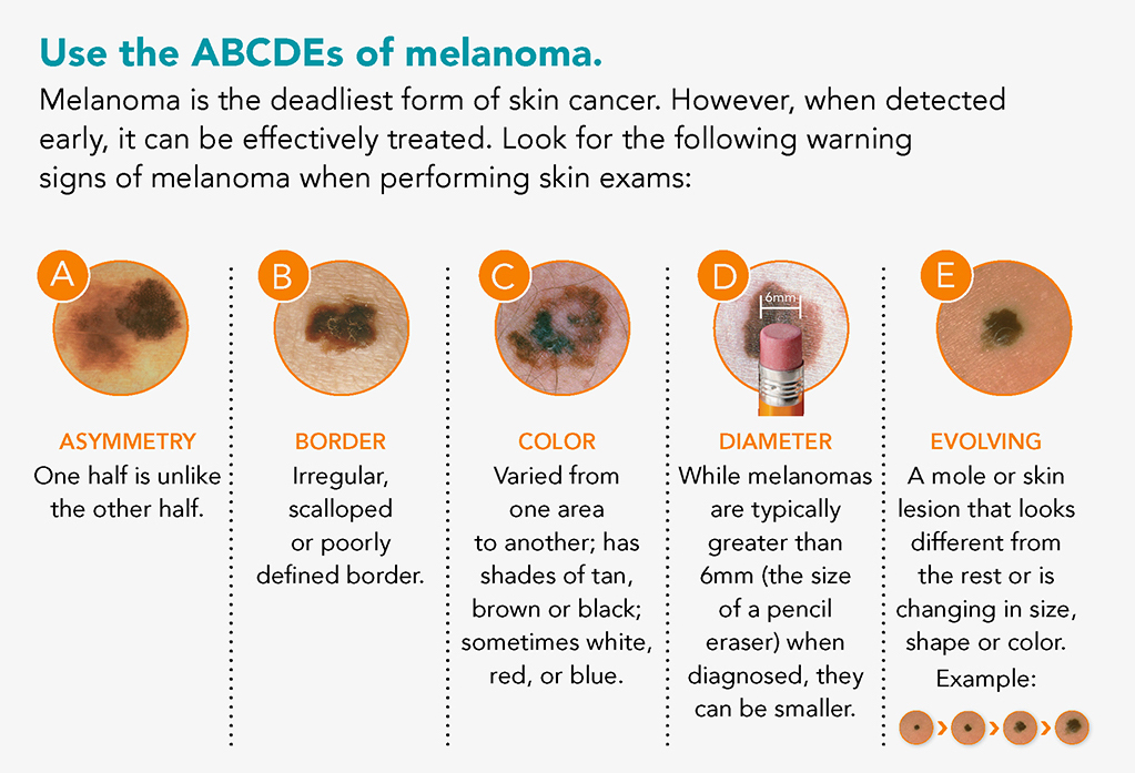 ABCDEs of Melanoma graphic