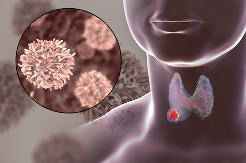 3D illustration showing thyroid gland with tumor inside human body and closeup view of thyroid cancer cells