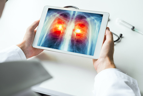 hands holding a tablet with image of lungs showing signs of cancer