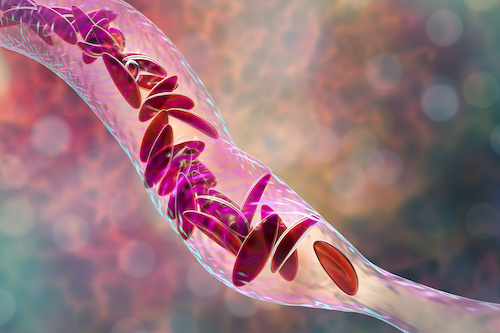 3D illustration Clumps of sickle cell block the blood vessel