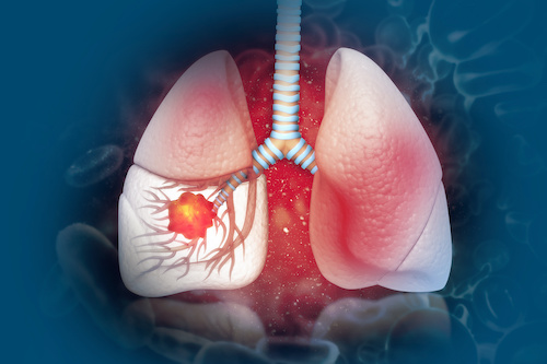 illustration of lungs with inflamed tumor