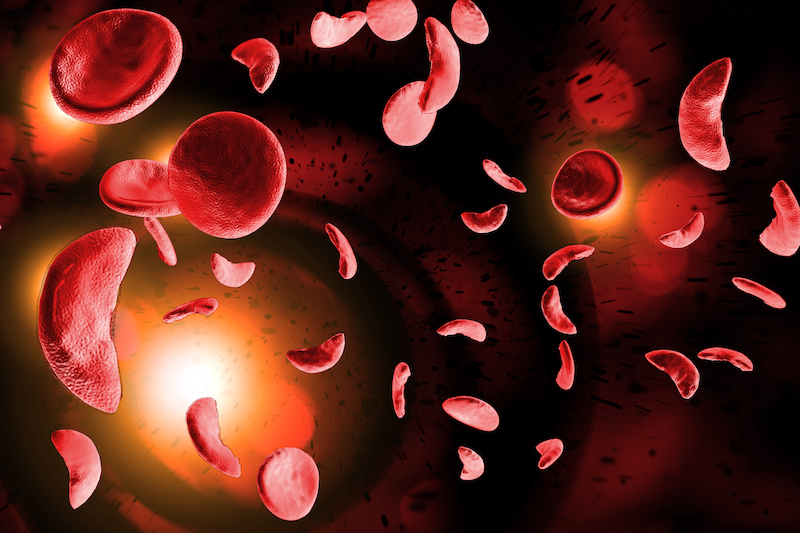 Sickle Cell Anemia 3D Illustration