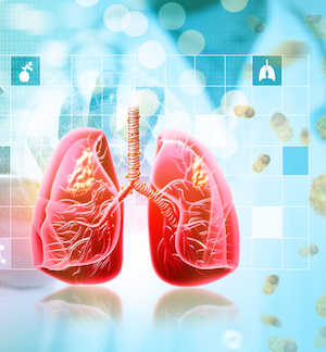 Human lungs with tumors, showing lung cancer or bronchial carcinoma, 3d illustration