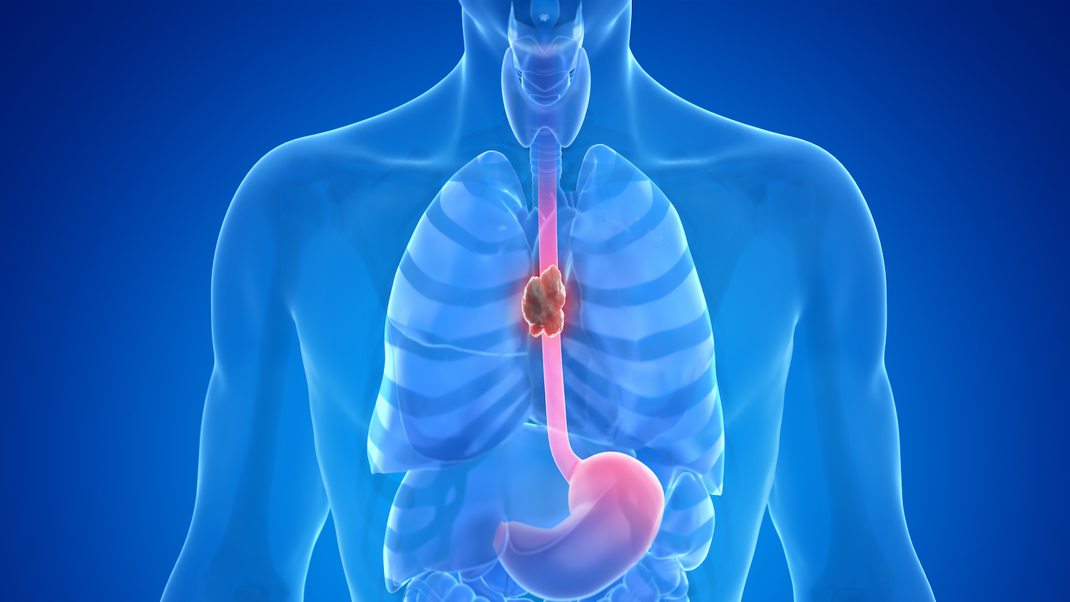 Blue anatomical model of esophageal cancer