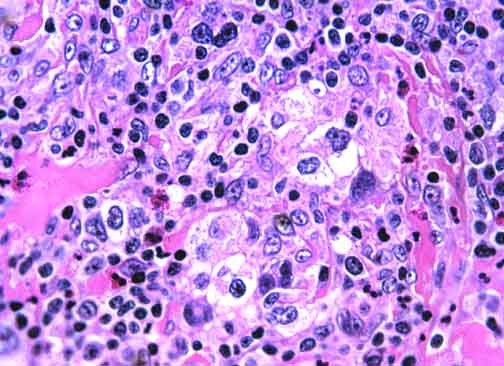 microscopic view of hodgkin lymphoma cells