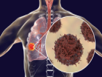 Lung cancer graphic