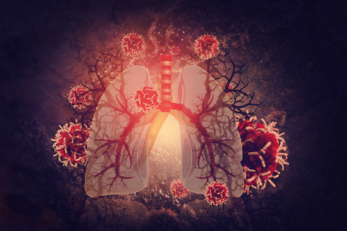 illustrated lung with cancer cells