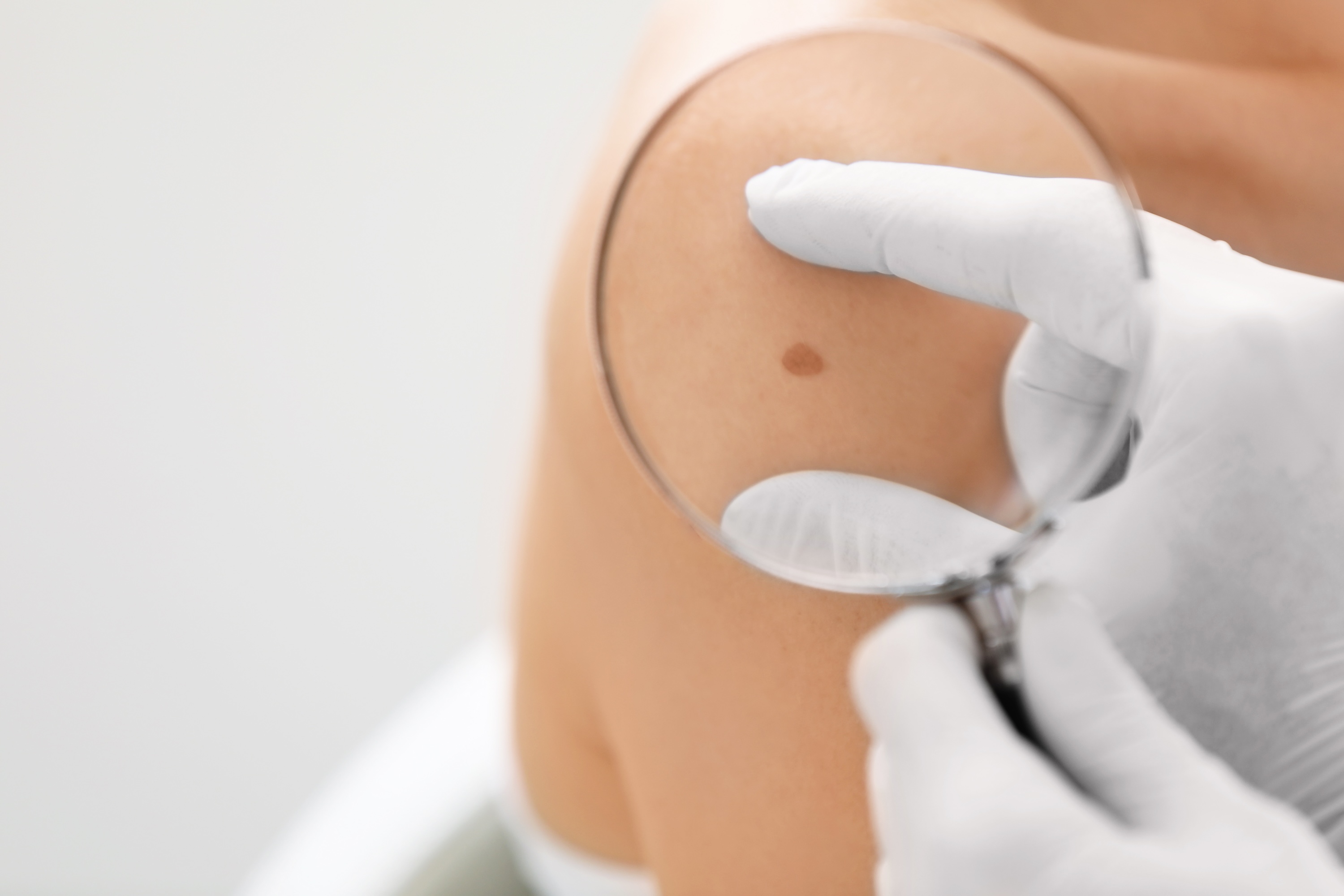 Doctor using magnifying glass to check mole on patient's skin
