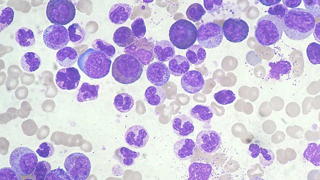 leukemia cells