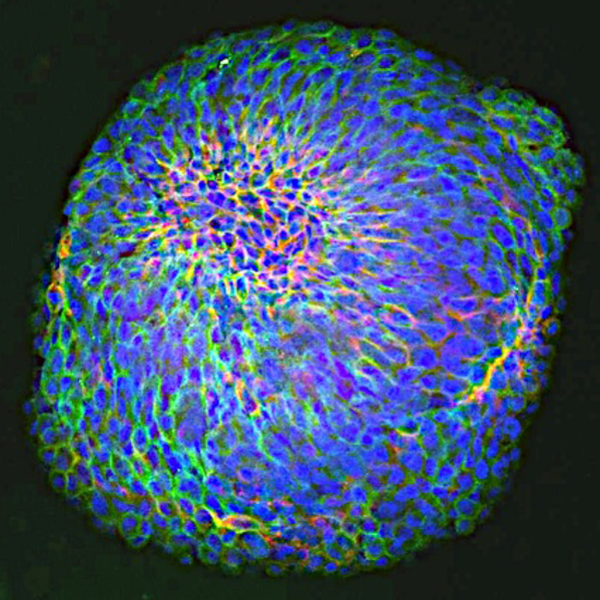 Immunofluorescence staining of 3D glioblastoma patient derived spheres
