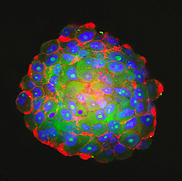 Immunofluorescence staining of 3D glioblastoma patient derived spheres