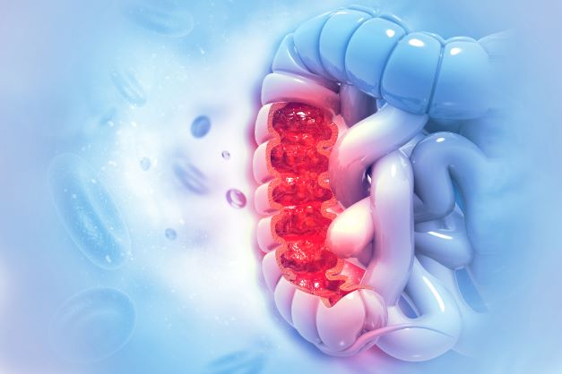 illustration of colon with irritated section indicating cancer