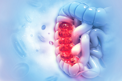 illustration of colon with cancerous growth