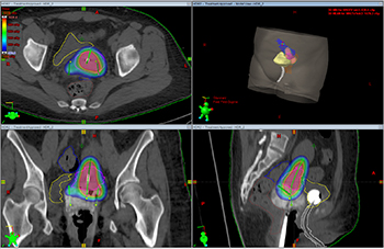 brachytherapy