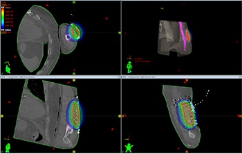 brachytherapy