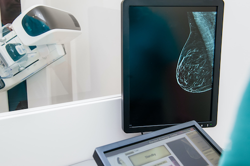 diagnostic image of a mammogram