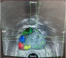 prostate biopsy procedure